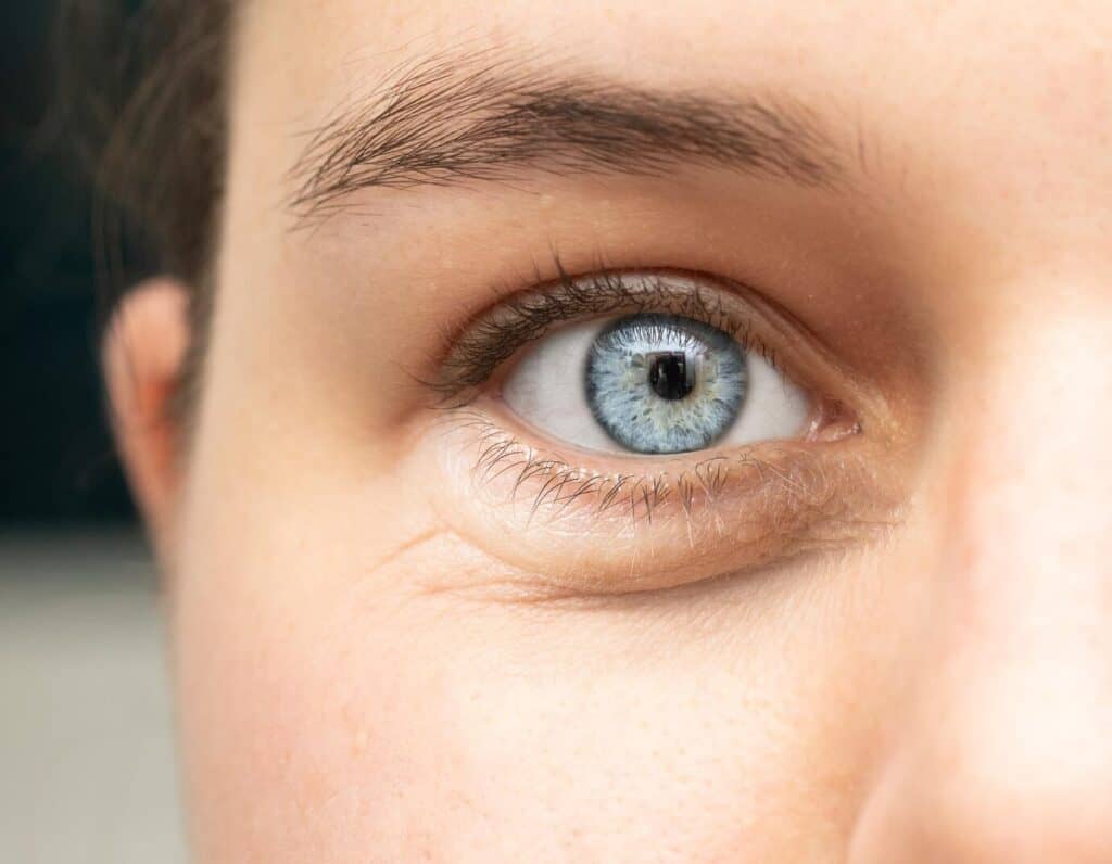 Tratamiento Ojeras (3 sesiones)